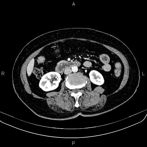 Adrenal myelolipoma (Radiopaedia 82742-96986 Axial renal cortical phase 87).jpg