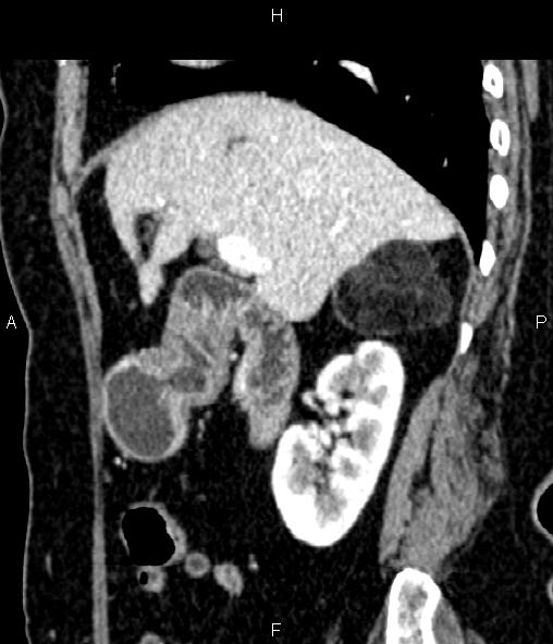 File:Adrenal myelolipoma (Radiopaedia 82742-96986 Sagittal renal cortical phase 40).jpg