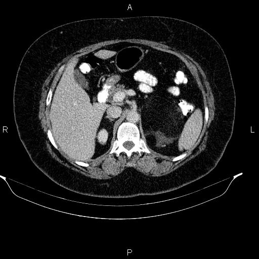 Adrenal myelolipoma (Radiopaedia 84319-99617 Axial renal cortical phase 39).jpg