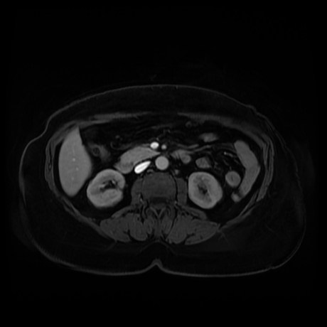 Adrenal myelolipoma - MRI (Radiopaedia 83249-97646 T1 fat sat arterial phase 51).jpg