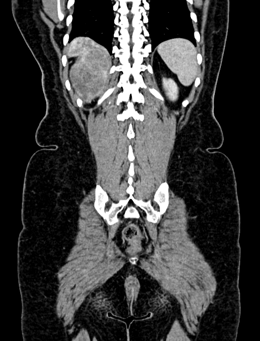Adrenocortical carcinoma (Radiopaedia 87281-103569 Coronal C+ portal venous phase 127).jpg
