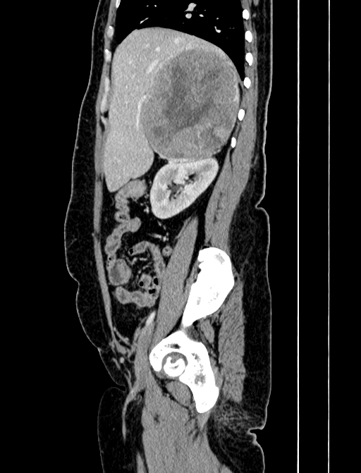 Adrenocortical carcinoma (Radiopaedia 87281-103569 Sagittal C+ portal venous phase 80).jpg
