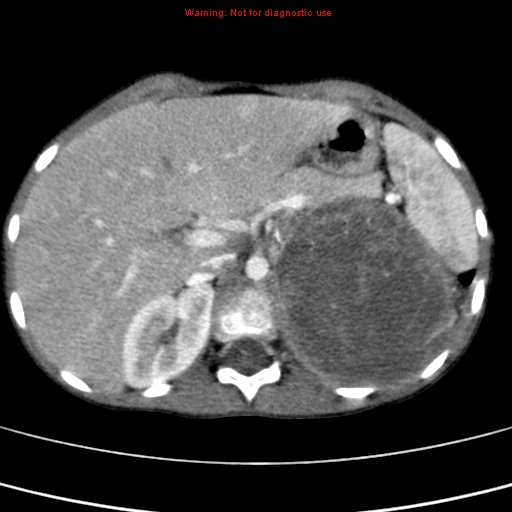 File:Adrenocortical carcinoma (Radiopaedia 9449-10131 Axial C+ portal venous phase 16).jpg