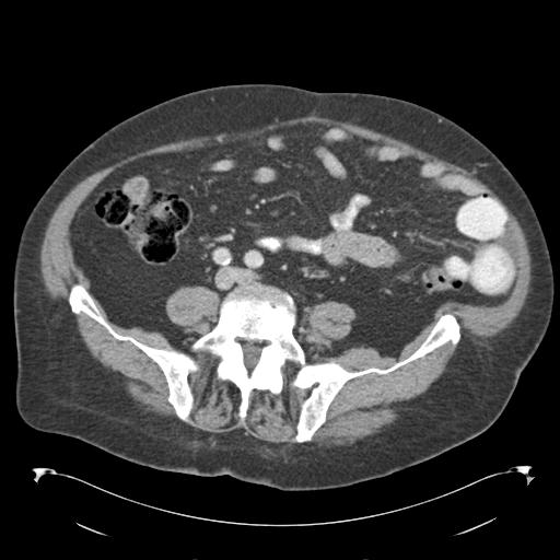 Adult ileal intussusception with secondary obstruction (Radiopaedia 30395-31051 Axial C+ portal venous phase 51).jpg