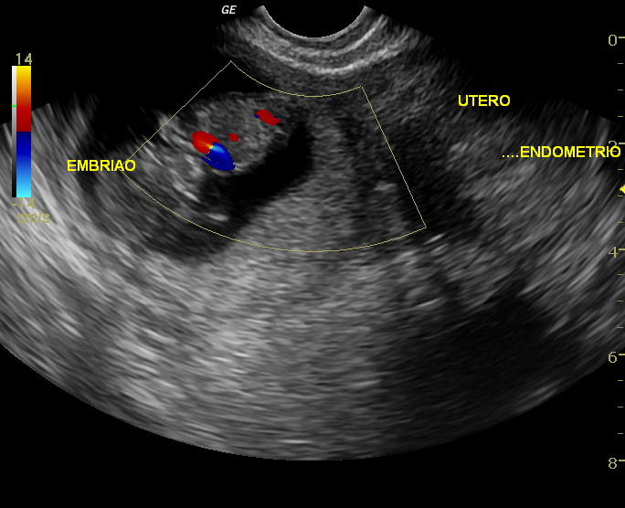 File:Advanced ectopic pregnancy (Radiopaedia 12862-12983 Oblique 1).jpg