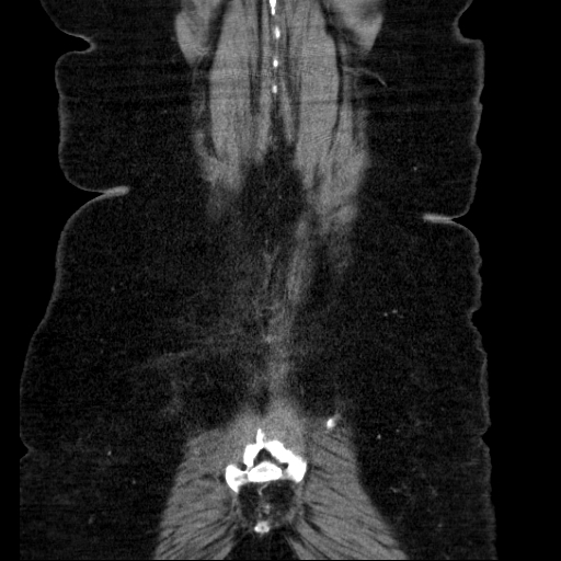 File:Afferent loop syndrome - secondary to incarcerated trocar site hernia (Radiopaedia 82959-97305 Coronal C+ portal venous phase 130).jpg