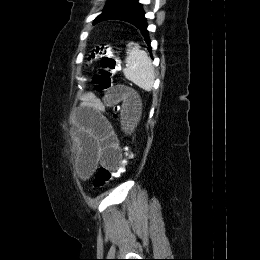 File:Afferent loop syndrome - secondary to incarcerated trocar site hernia (Radiopaedia 82959-97305 Sagittal C+ portal venous phase 23).jpg