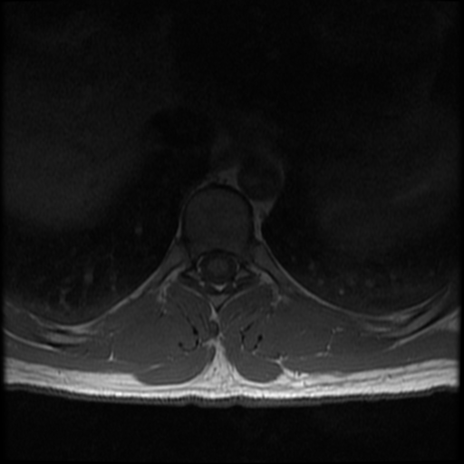 File:Aggressive vertebral hemangioma (Radiopaedia 39937-42404 Axial T1 14).png
