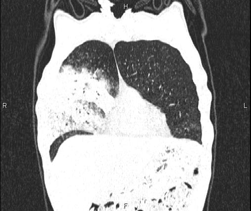 Air bronchogram in pneumonia (Radiopaedia 85719-101512 Coronal lung window 11).jpg