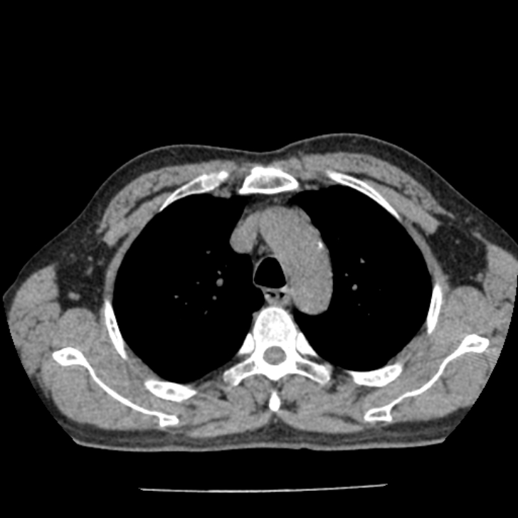 Airway foreign body in adult (Radiopaedia 85907-101779 Axial liver window 34).jpg