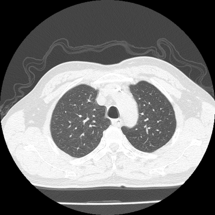 Airway foreign body in adult (Radiopaedia 85907-101779 Axial lung window 28).jpg