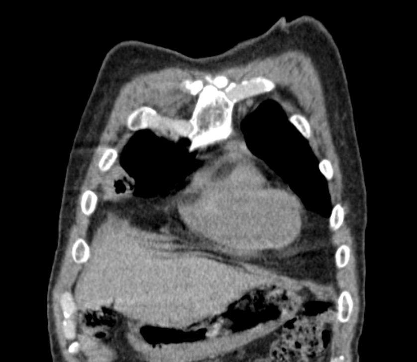 Airway foreign body in adult (Radiopaedia 85907-101779 Coronal liver window 33).jpg