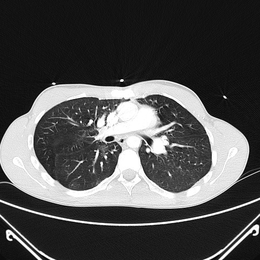 File:Alagille syndrome with pulmonary hypertension (Radiopaedia 49384-54980 Axial lung window 3).jpg