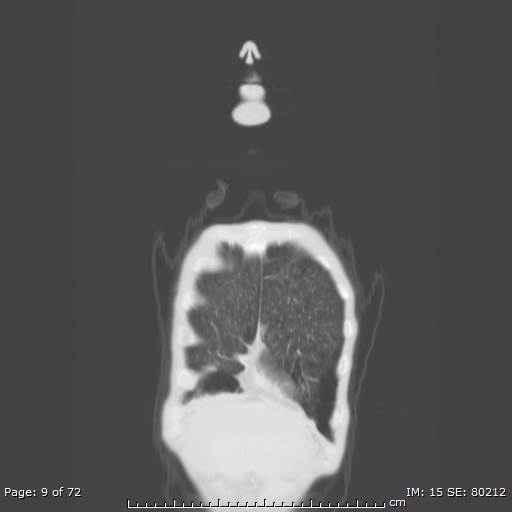 Alpha-1-antitrypsin deficiency (Radiopaedia 50561-55987 Coronal lung window 7).jpg