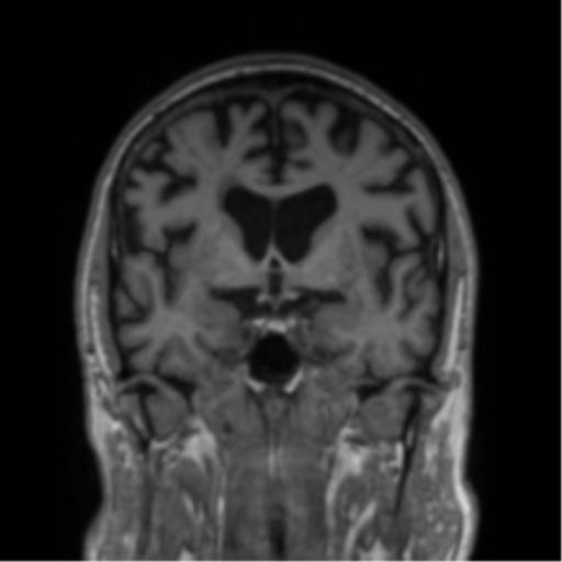 Alzheimer's disease- with Gerstmann syndrome and dressing apraxia (Radiopaedia 54882-61150 Coronal T1 53).png