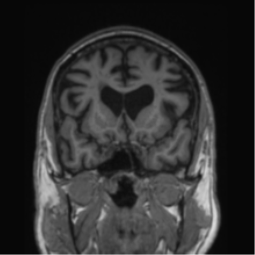 Alzheimer's disease- with Gerstmann syndrome and dressing apraxia (Radiopaedia 54882-61150 Coronal T1 59).png