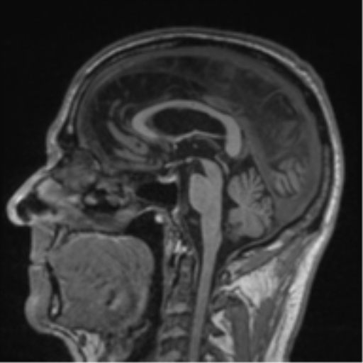 Alzheimer's disease- with Gerstmann syndrome and dressing apraxia (Radiopaedia 54882-61150 Sagittal T1 35).png