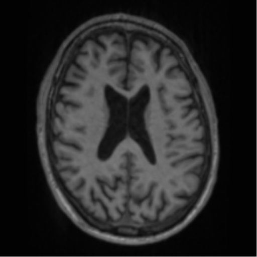 File:Alzheimer's disease- with apraxia (Radiopaedia 54763-61011 Axial T1 46).png