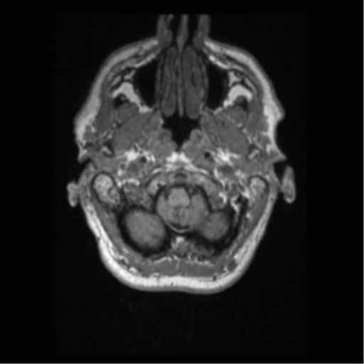 File:Alzheimer disease - probable (Radiopaedia 35334-36837 Axial T1 11).png