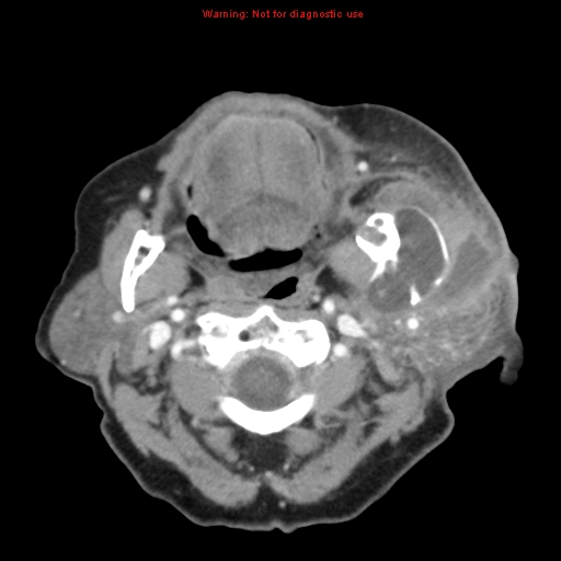 Ameloblastoma (Radiopaedia 27437-27631 A 32).jpg