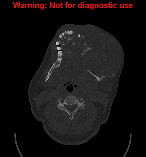 File:Ameloblastoma (Radiopaedia 33126-34164 Axial bone window 16).jpg