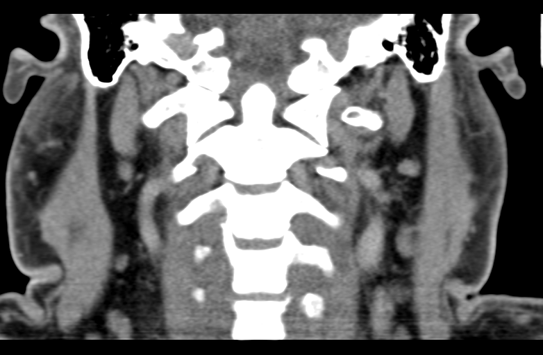 Ameloblastoma (Radiopaedia 33677-34806 Coronal non-contrast 48).png
