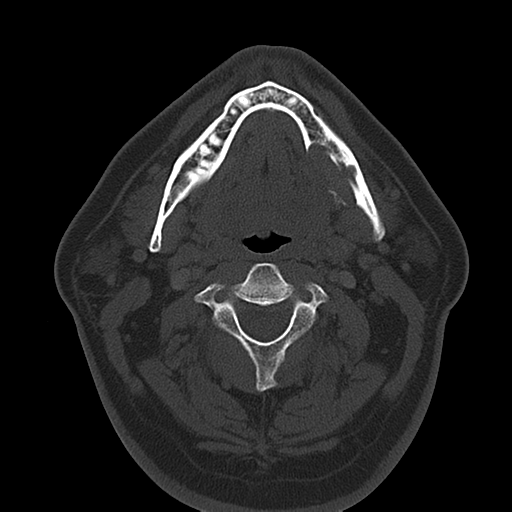 Ameloblastoma (Radiopaedia 38520-40623 Axial bone window 33).png