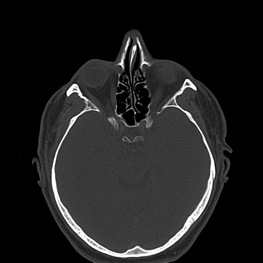 Ameloblastoma (Radiopaedia 38520-40623 Axial bone window 5).png
