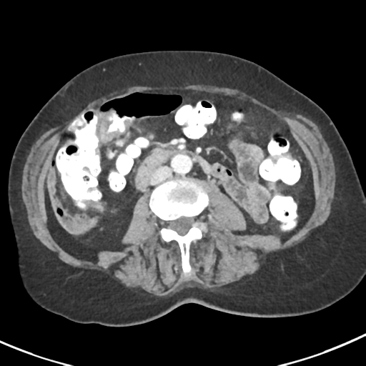 Ampullary adenocarcinoma (Radiopaedia 34013-35237 C 26).png