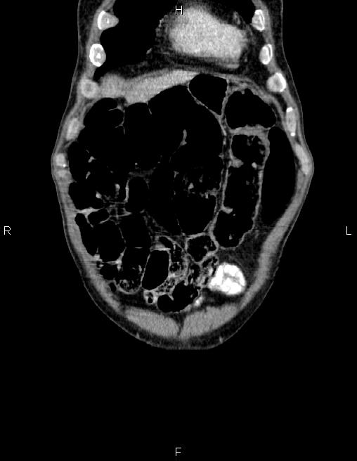 Ampullary adenocarcinoma (Radiopaedia 86093-102032 C 6).jpg