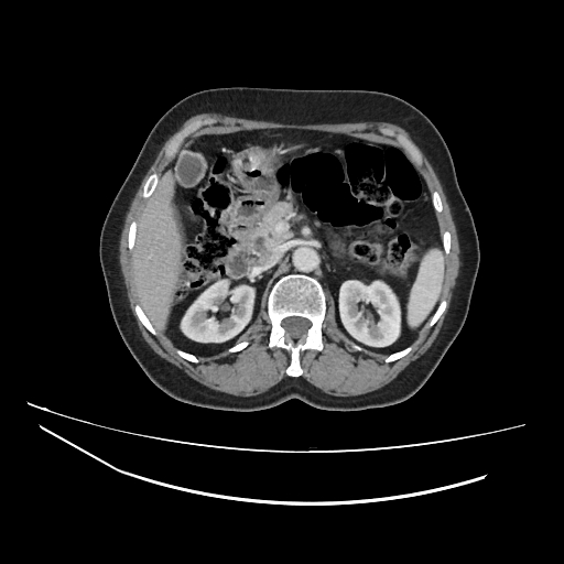 Ampullary tumor (Radiopaedia 60333-67998 A 26).jpg