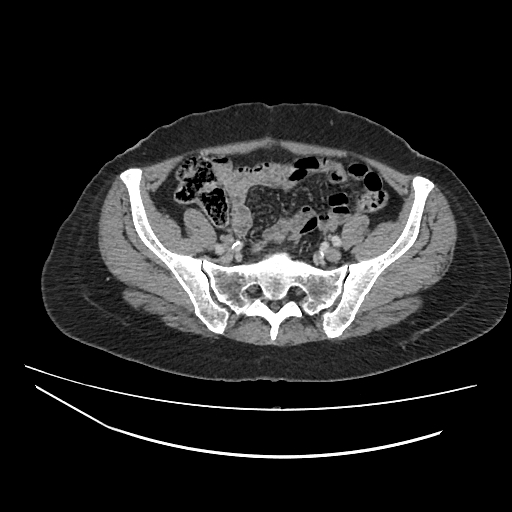 Ampullary tumor (Radiopaedia 60333-67998 A 69).jpg