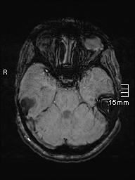 File:Amyotrophic lateral sclerosis (Radiopaedia 70821-81017 Axial SWI 13).jpg