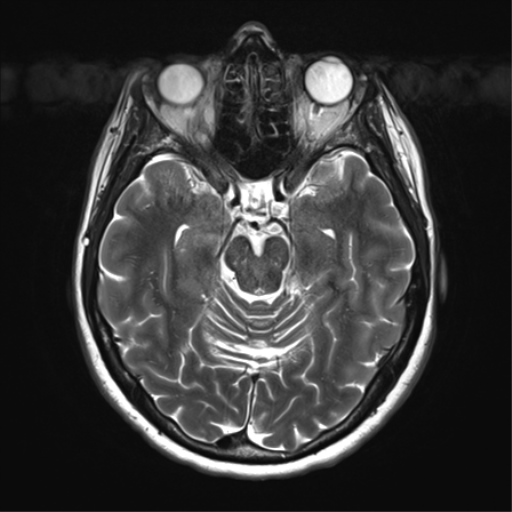 File:Anaplastic astrocytoma - thalamic glioma (Radiopaedia 59709-67115 Axial T2 14).png