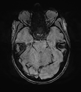 File:Anaplastic astrocytoma IDH mutant (Radiopaedia 50046-55341 Axial SWI 30).png