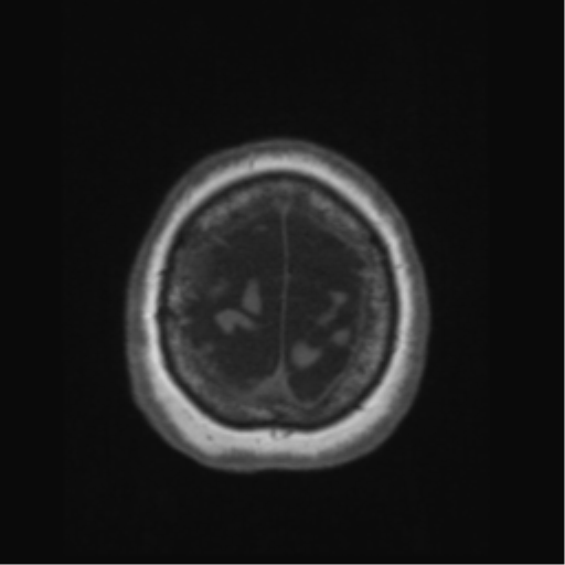 File:Anaplastic astrocytoma IDH wild-type (pseudoprogression) (Radiopaedia 42209-45276 Axial T1 137).png