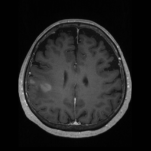 File:Anaplastic astrocytoma IDH wild-type (pseudoprogression) (Radiopaedia 42209-45276 Axial T1 C+ 99).png