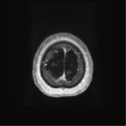 Anaplastic astrocytoma IDH wild-type (pseudoprogression) (Radiopaedia 42209-45279 Axial T1 C+ 133).png