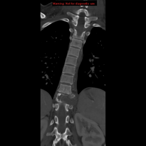 File:Aneurysmal bone cyst (Radiopaedia 9419-10102 Coronal bone window 11).jpg