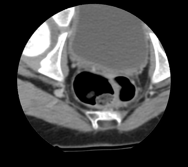 Aneurysmal bone cyst - sacrum (Radiopaedia 65190-74195 Axial non-contrast 43).jpg