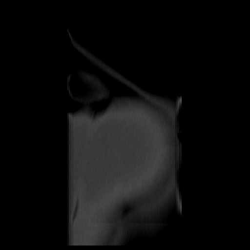 File:Aneurysmal bone cyst - sacrum (Radiopaedia 65190-74195 Coronal bone window 21).jpg
