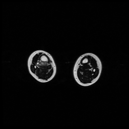 File:Aneurysmal bone cyst - tibia (Radiopaedia 22343-22367 Axial T2 8).jpg