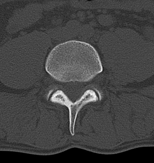 File:Aneurysmal bone cyst T11 (Radiopaedia 29294-29721 Axial bone window 103).jpg