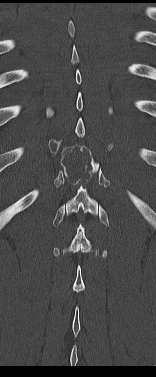 Aneurysmal bone cyst T11 (Radiopaedia 29294-29721 Coronal bone window 52).jpg