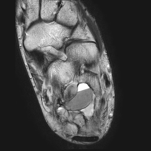 File:Aneurysmal bone cyst of the calcaneus (Radiopaedia 60669-68420 Axial T2 13).jpg