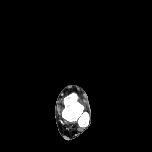 File:Aneurysmal bone cyst of the calcaneus (Radiopaedia 60669-68421 A 17).jpg