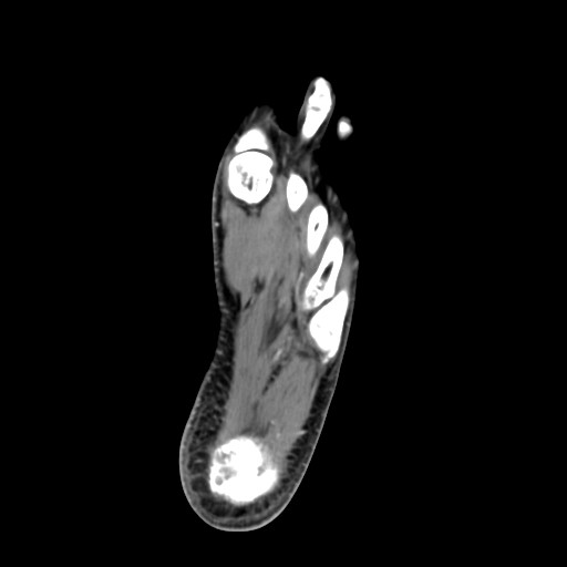 File:Aneurysmal bone cyst of the calcaneus (Radiopaedia 60669-68421 A 38).jpg