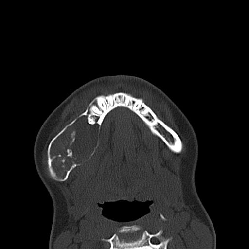 File:Aneurysmal bone cyst of the mandible (Radiopaedia 43280-46601 Axial bone window 14).jpg