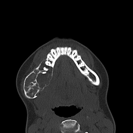 Aneurysmal bone cyst of the mandible (Radiopaedia 43280-46601 Axial bone window 18).jpg