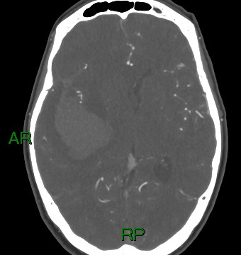 File:Aneurysmal subarachnoid hemorrhage with intra-axial extension (Radiopaedia 84371-99732 A 22).jpg